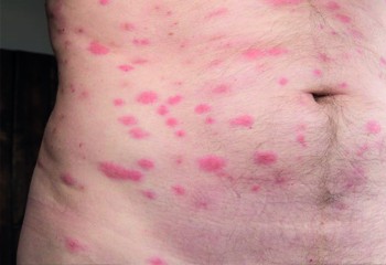  Jeukende bulten lijkt op muggenbulten